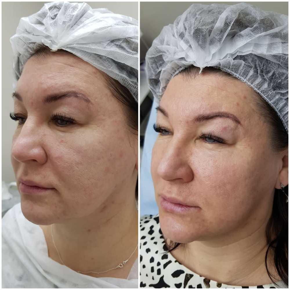 Аутоплазмотерапия Meaplasma лица — фото до и после 1
