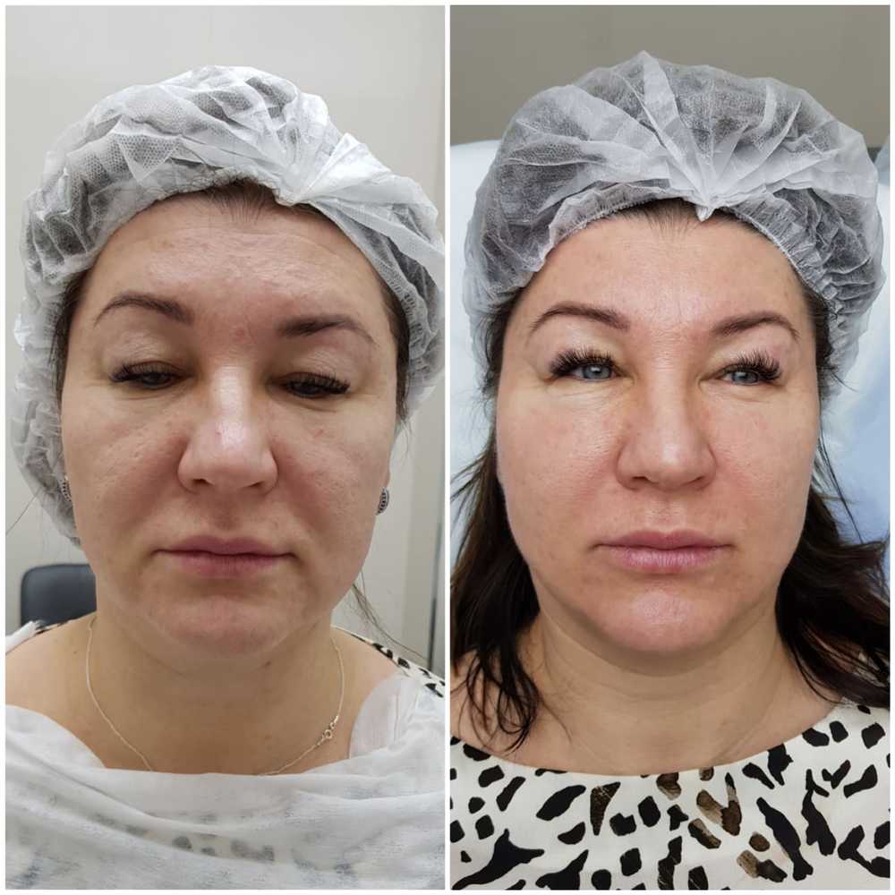 Аутоплазмотерапия Meaplasma лица — фото до и после