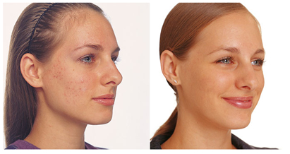 Угревая сыпь — фото до и после лечения