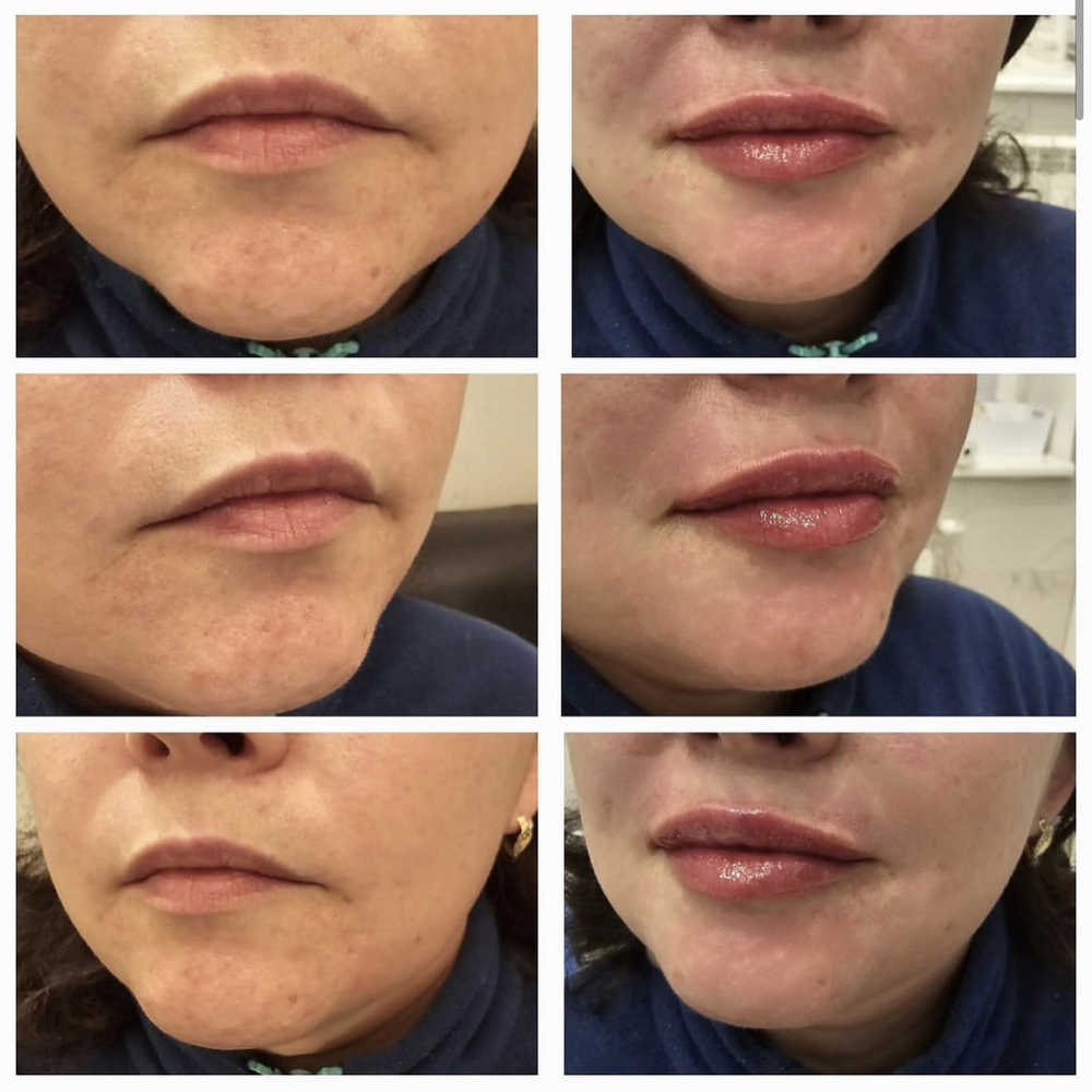 Корреция губ препаратом Stylage M Bi-SOFT Lidocaine (фото 12.04.24)